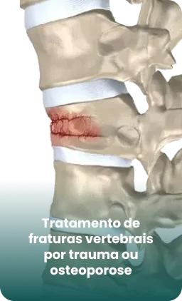 fraturas-vertebrais